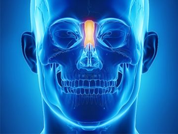Искривление носовой перегородки