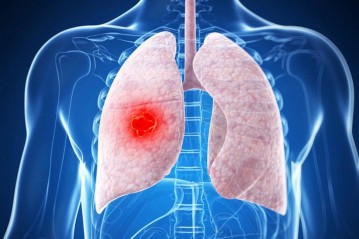 Метастазы лёгких